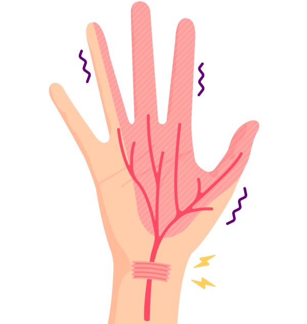 Carpal Tunnel Syndrome Illustration