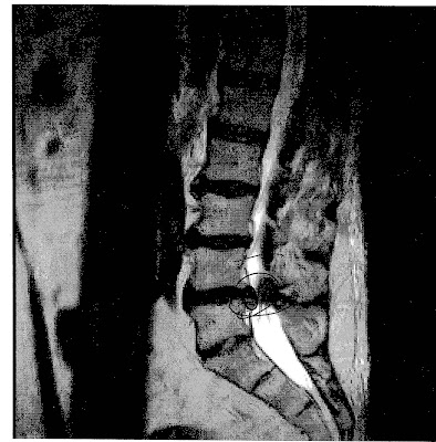 overcoming disc herniation